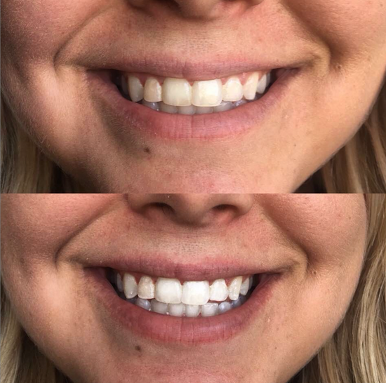 Close-up of a person's smile showing teeth before and after whitening.