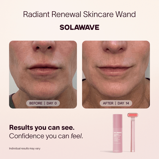 Before and after comparison of a person's face using a Radiant Renewal Skincare Wand by Solawave, with product packaging shown below.