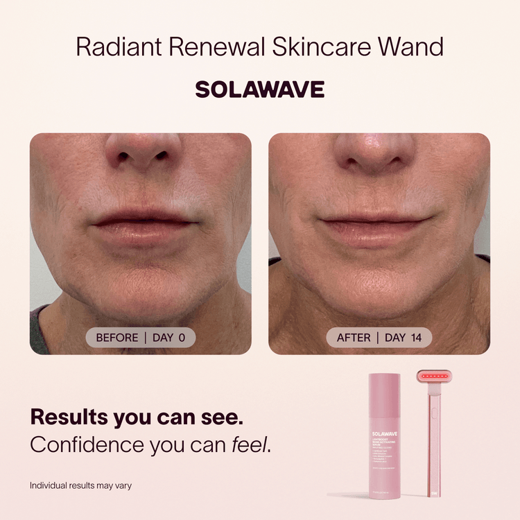 Before and after comparison of a person's face using a Radiant Renewal Skincare Wand by Solawave, with product packaging shown below.